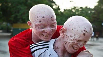 Albino Murders